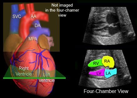 محدودیت های دیدگاه چهارگانه قلب - اکوکاردیوگرافی جنین