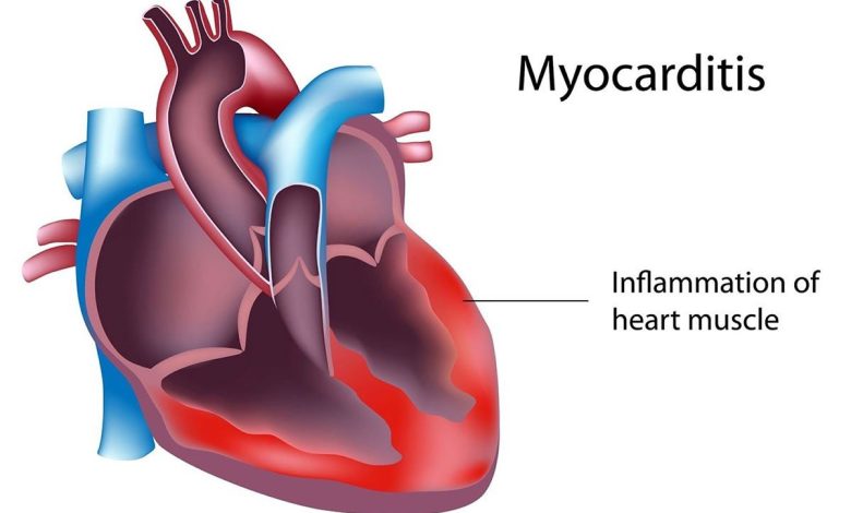 التهاب عضله قلب | علائم، علل و درمان میوکاردیت