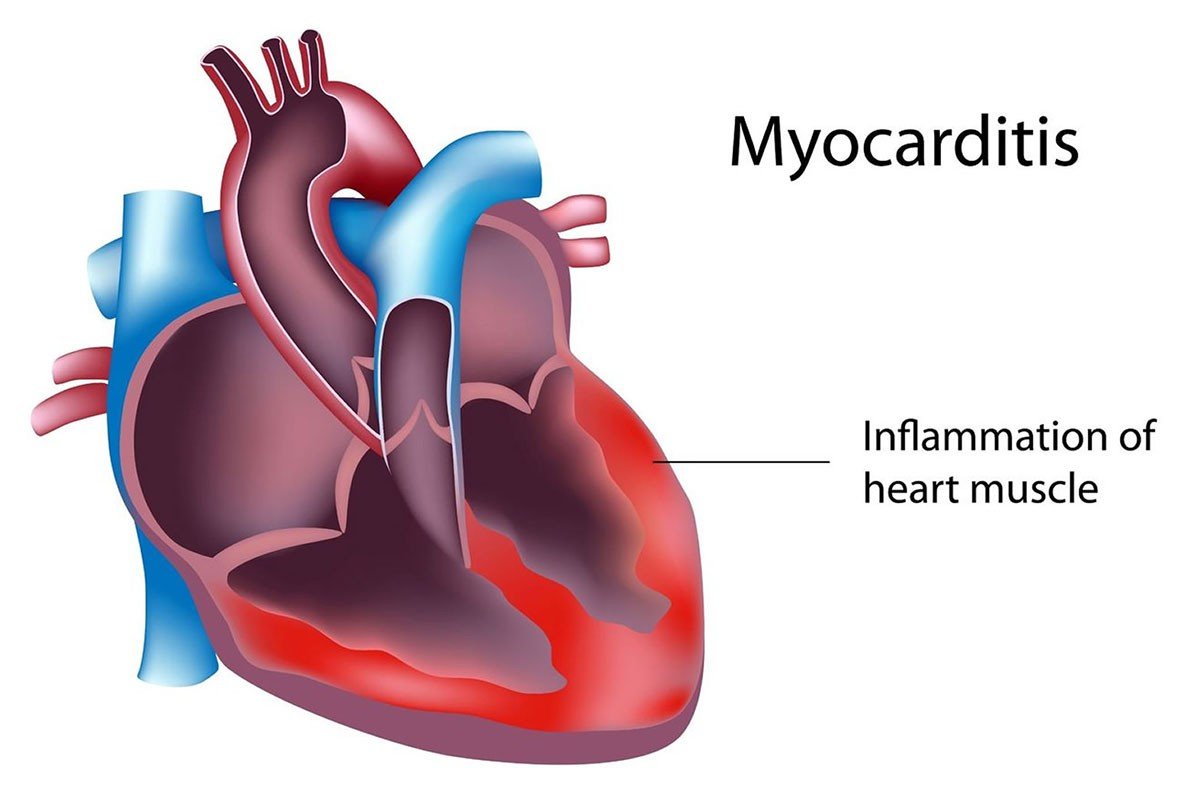 التهاب عضله قلب | علائم، علل و درمان میوکاردیت
