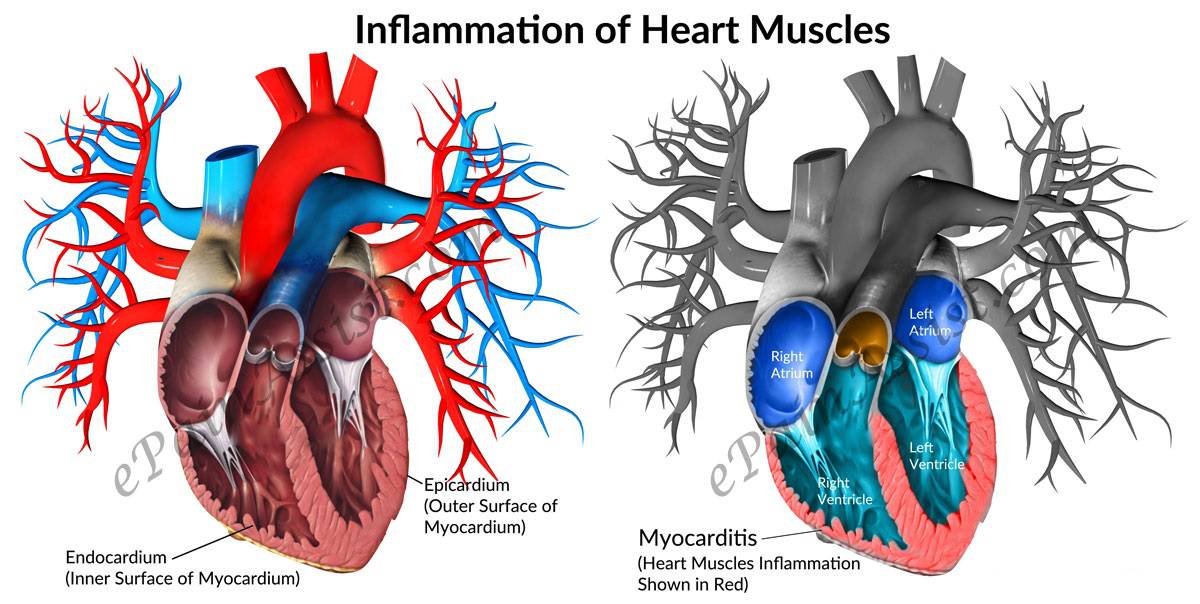پریکاردیت قلب یک بیماری قلبی است + علائم و تشخیص راه درمان