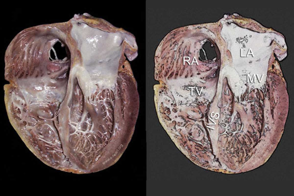 اکوی قلب در کاردیومیوپاتی چه نقشی دارد و چگونه به درمان کمک می کند؟