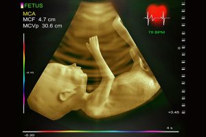 تست اکوکاردیوگرام جنین و بیماری قلبی مادرزادی