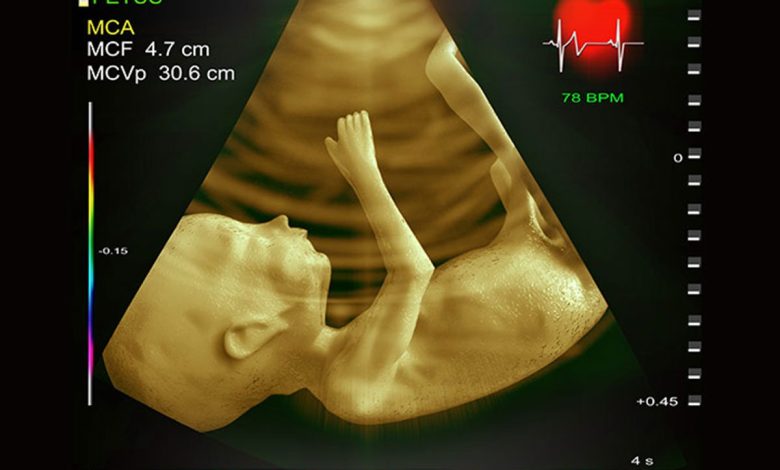 تفسیر جواب اکو قلب جنین در تشخیص بیماری قلبی مادرزادی