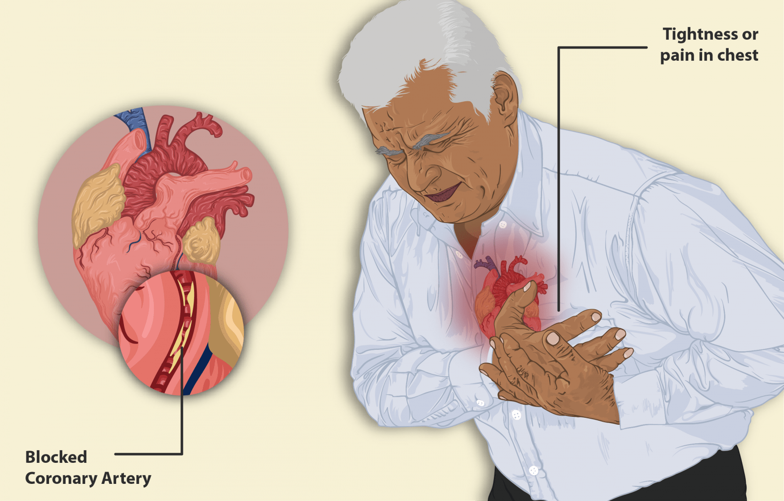 آنژین چیست، چه علائمی دارد و درمان آن کدام است؟ مرکز قلب، عروق و