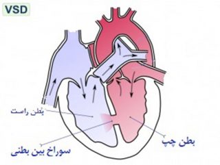 نقص دیواره بین بطنی