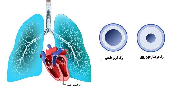 فشار خون ریوی