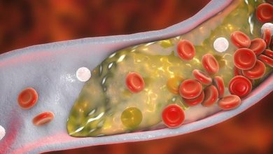 بیماری تنگی عروق و انسداد کاروتید