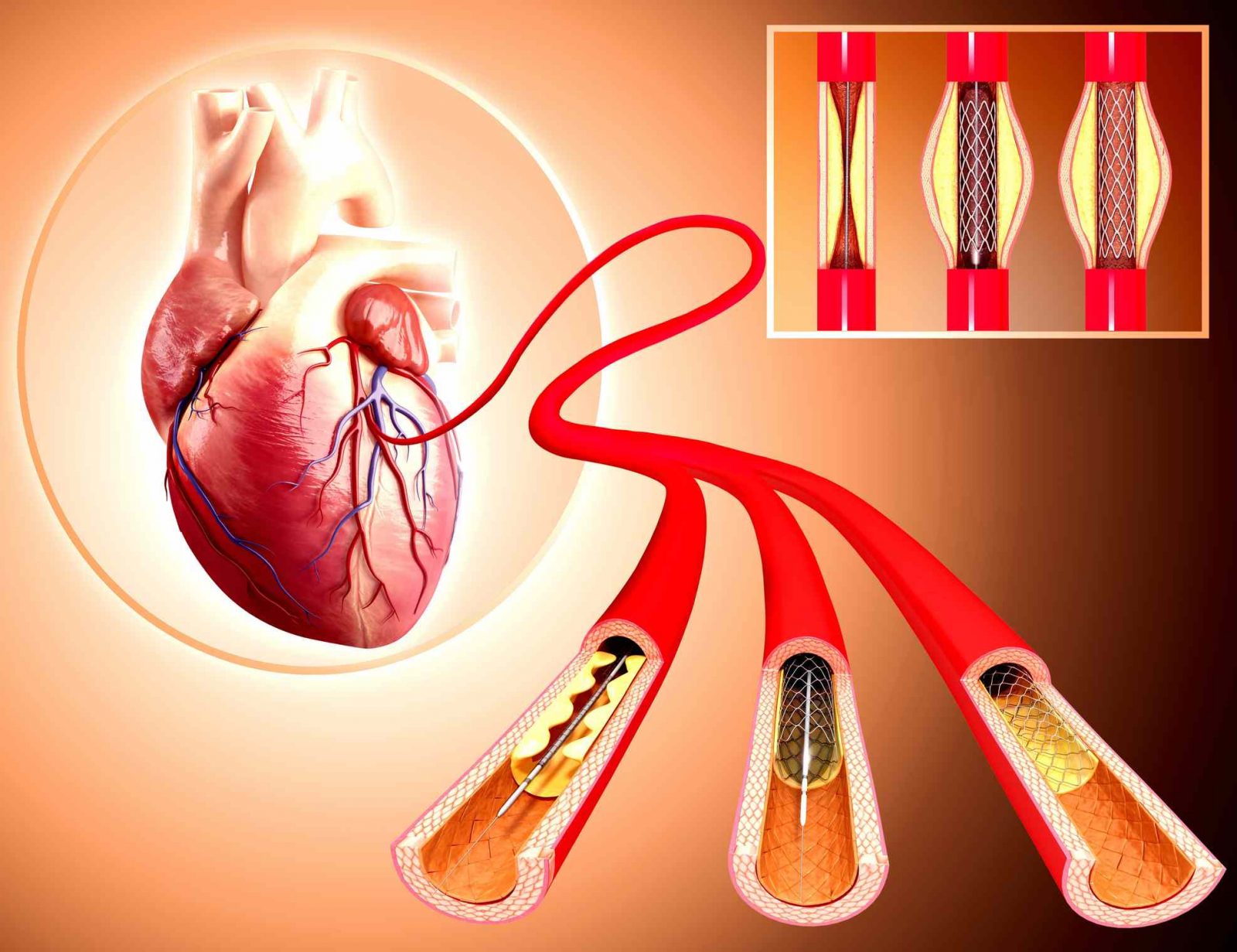  آنژیوپلاستی و درمان بیماری های قلبی