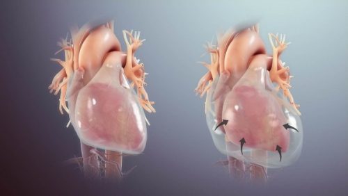  اکوکاردیوگرافی و تشخیص تامپوناد قلبی