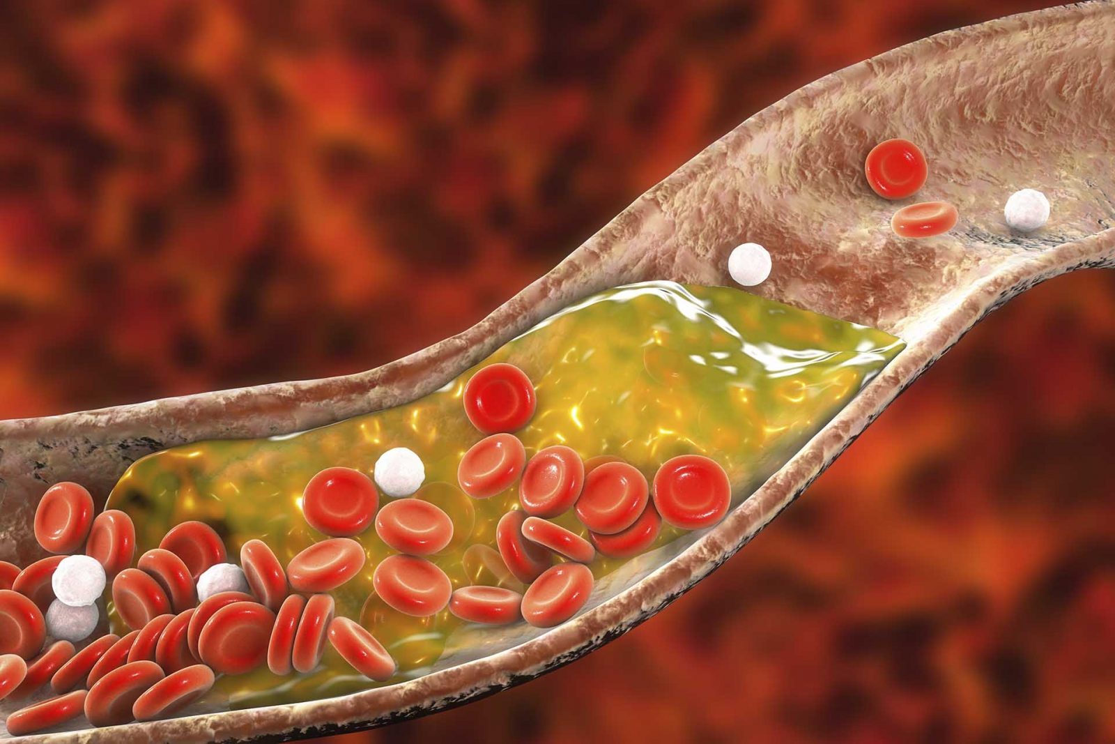 چربی خون نوع 3 | دیس بتالیپوپروتئینمیا