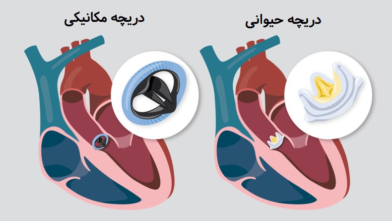 دریچه قلب مصنوعی