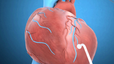 بازسازی عروق با روش لیزر ترانس میوکارد