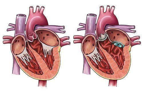جراحی تعویض دریچه قلب