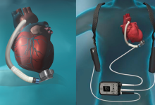 انواع دستگاه کمک بطنی