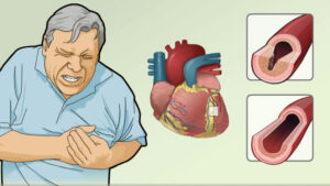 آنژین پایدار