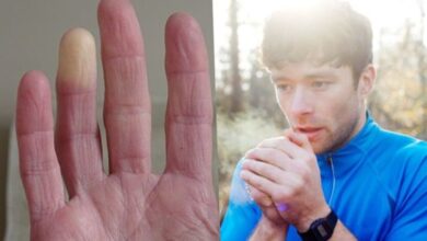 بیماری رینود