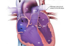 اتصال غیر عادی وریدی ریوی کامل