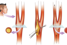 اندارترکتومی کاروتید