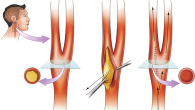 اندارترکتومی کاروتید