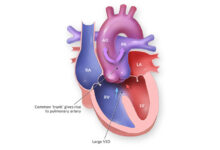 تنه مشترک شریانی