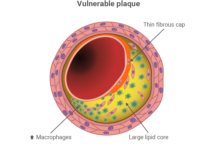 پلاک آسیب پذیر