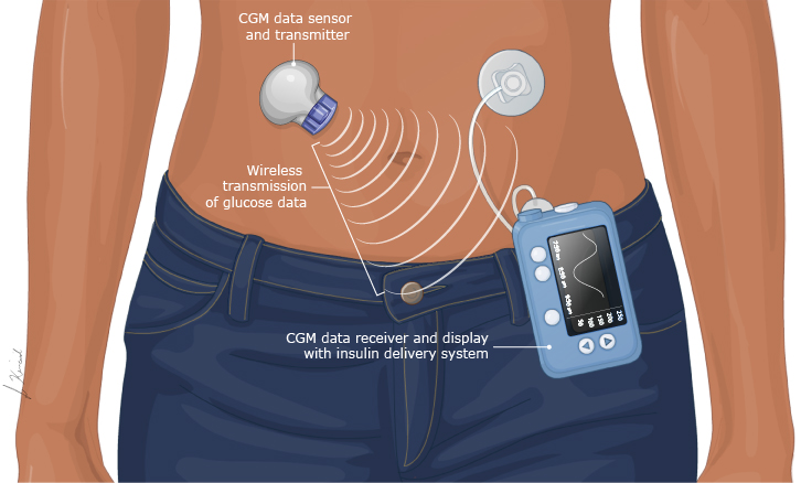 پمپ انسولین با CGM